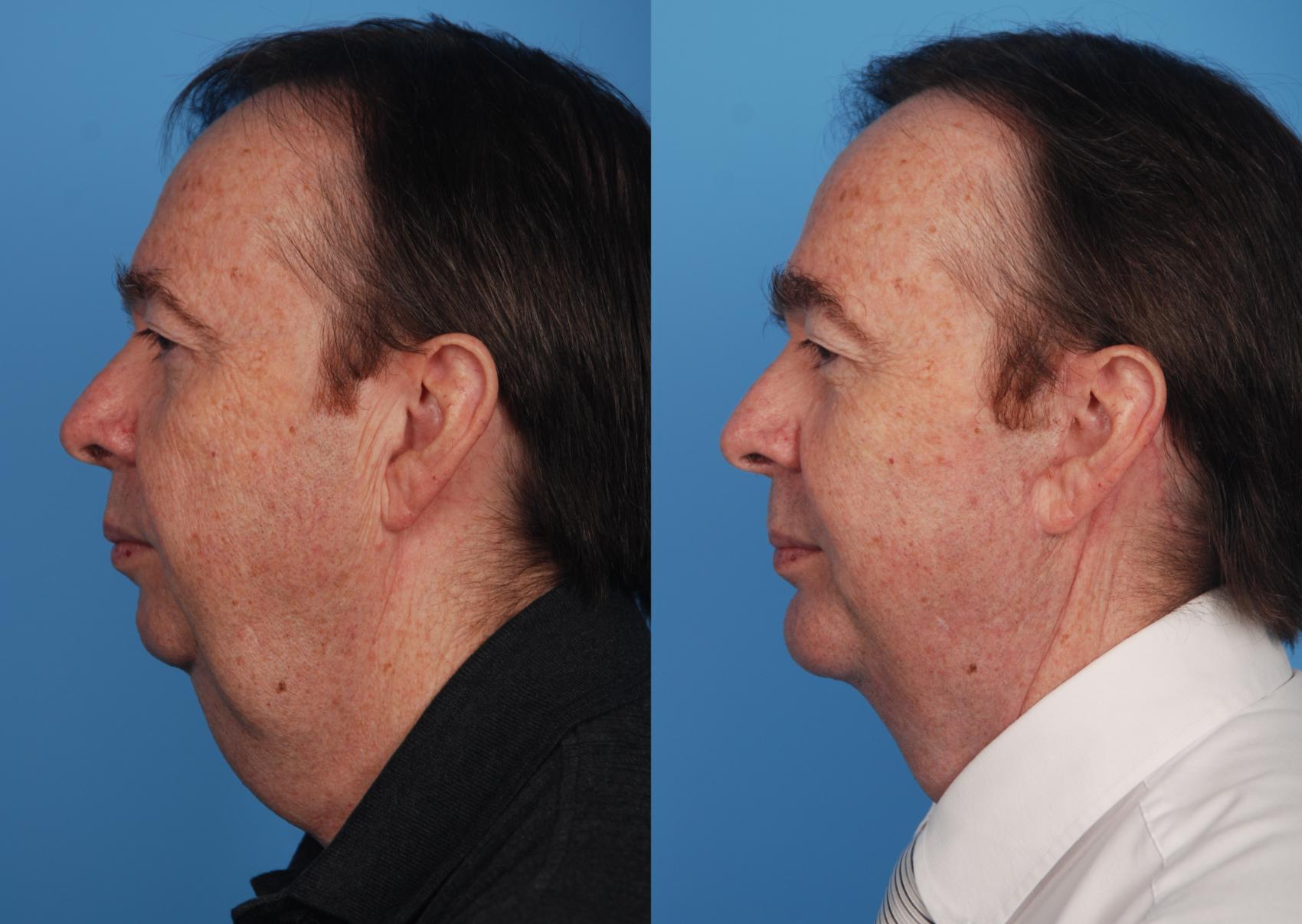 Before & After Chin Augmentation Case 23 View #1 View in Toronto, ON