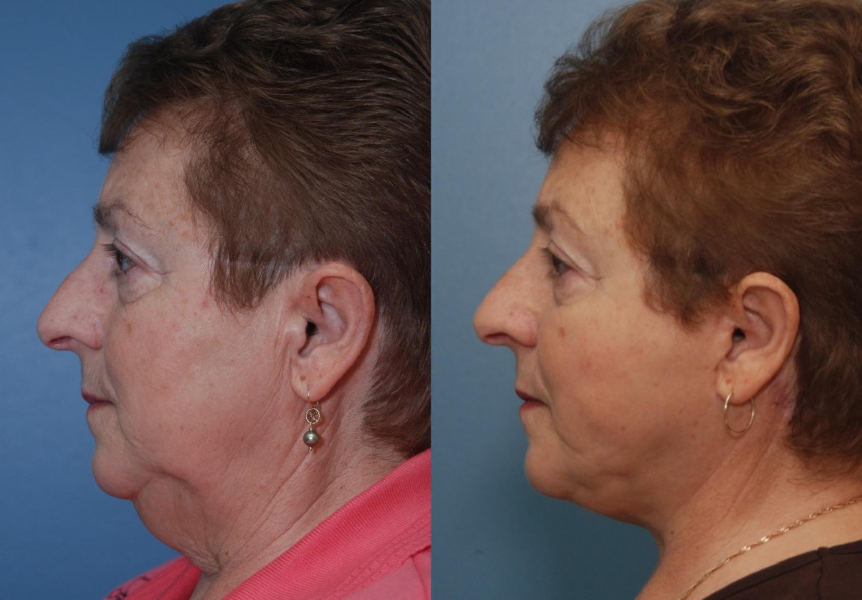 Before & After Facelift/Neck Lift Case 111 View #1 View in Toronto, ON