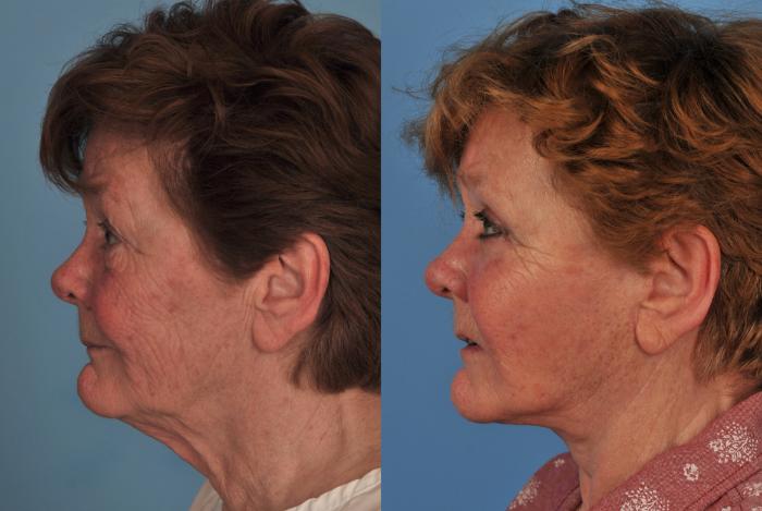 Before & After Facelift/Neck Lift Case 112 View #1 View in Toronto, ON