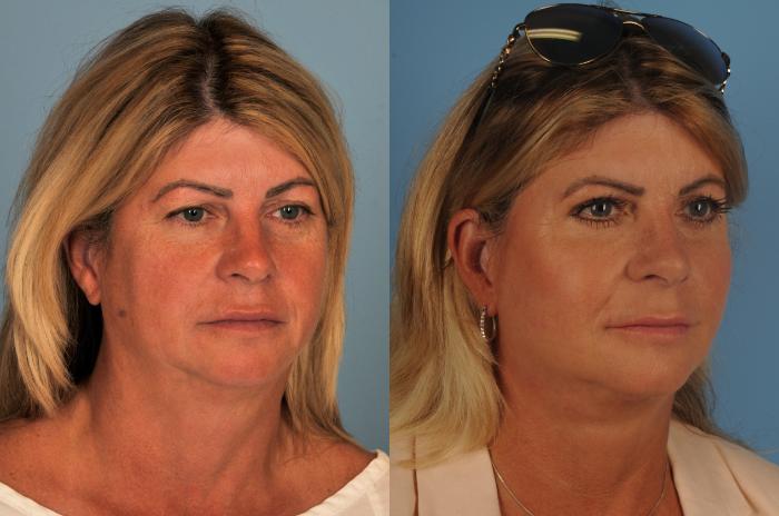 Before & After Facelift/Neck Lift Case 130 View #1 View in Toronto, ON