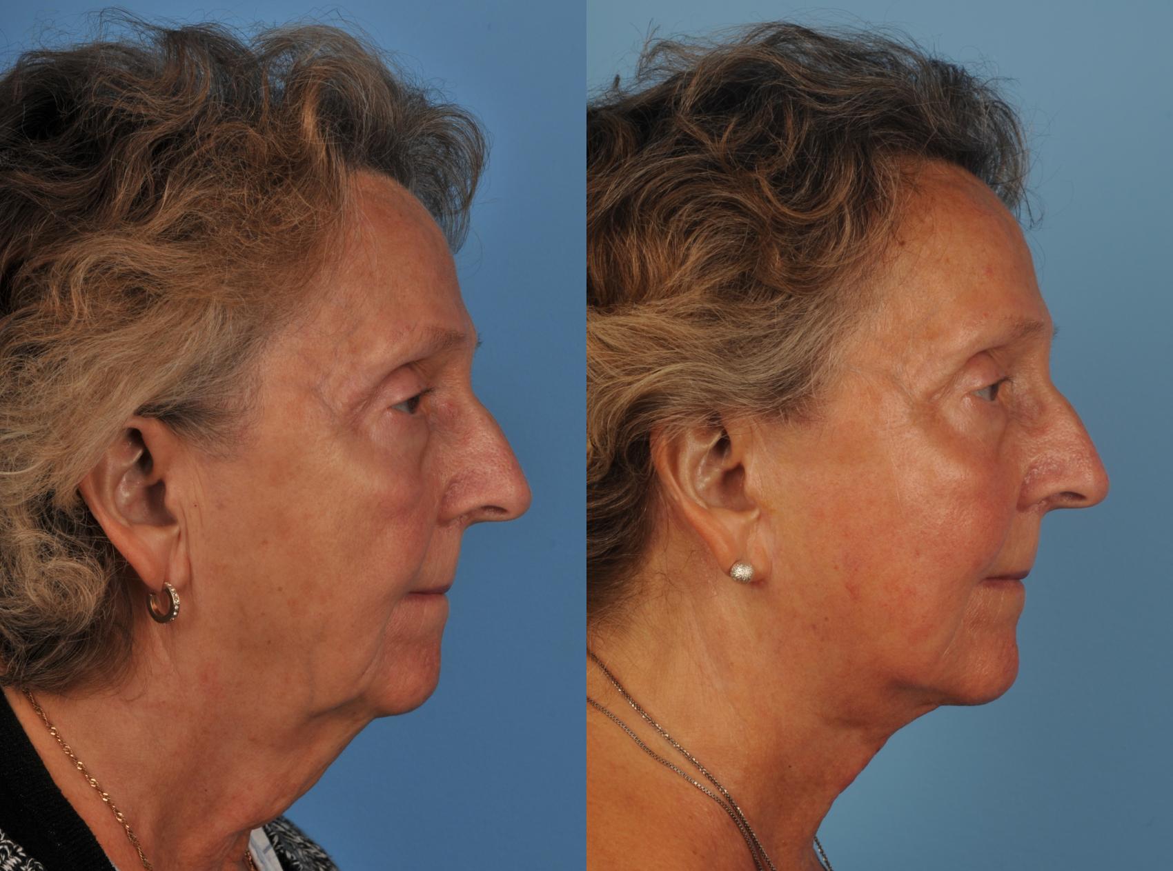 Before & After Facelift/Neck Lift Case 136 View #1 View in Toronto, ON