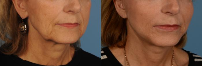 Before & After Facelift/Neck Lift Case 145 View #1 View in Toronto, ON
