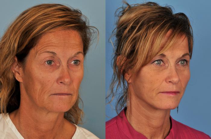 Before & After Facelift/Neck Lift Case 164 View #1 View in Toronto, ON