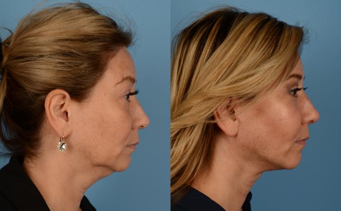 Before & After Facelift/Neck Lift Case 167 View #1 View in Toronto, ON