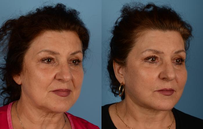 Before & After Facelift/Neck Lift Case 168 View #1 View in Toronto, ON