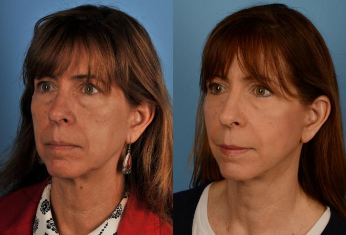 Before & After Facelift/Neck Lift Case 169 View #1 View in Toronto, ON