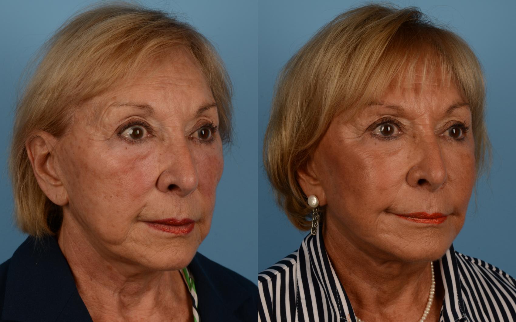 Before & After Facelift/Neck Lift Case 170 View #1 View in Toronto, ON