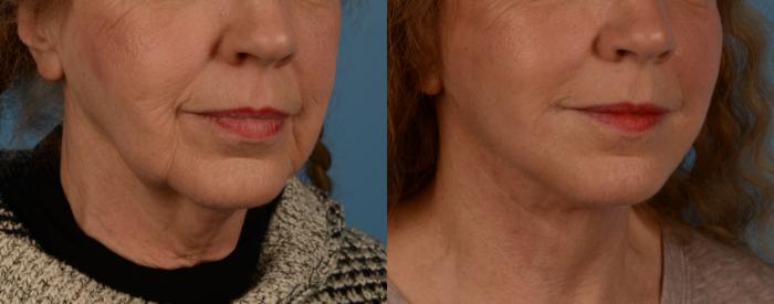 Before & After Facelift/Neck Lift Case 184 View #1 View in Toronto, ON