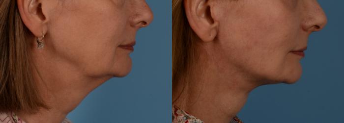 Before & After Facelift/Neck Lift Case 189 View #1 View in Toronto, ON