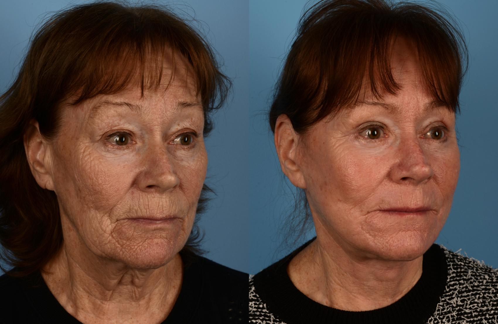 Before & After Facelift/Neck Lift Case 197 View #1 View in Toronto, ON