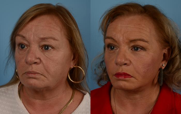Before & After Facelift/Neck Lift Case 198 View #1 View in Toronto, ON