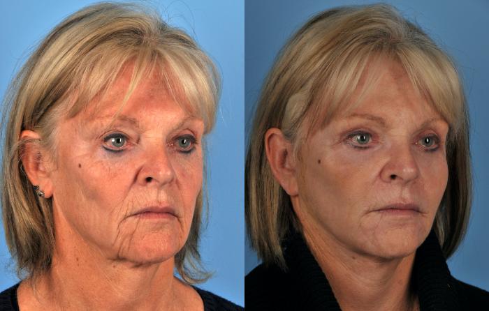 Before & After Facelift/Neck Lift Case 201 View #1 View in Toronto, ON