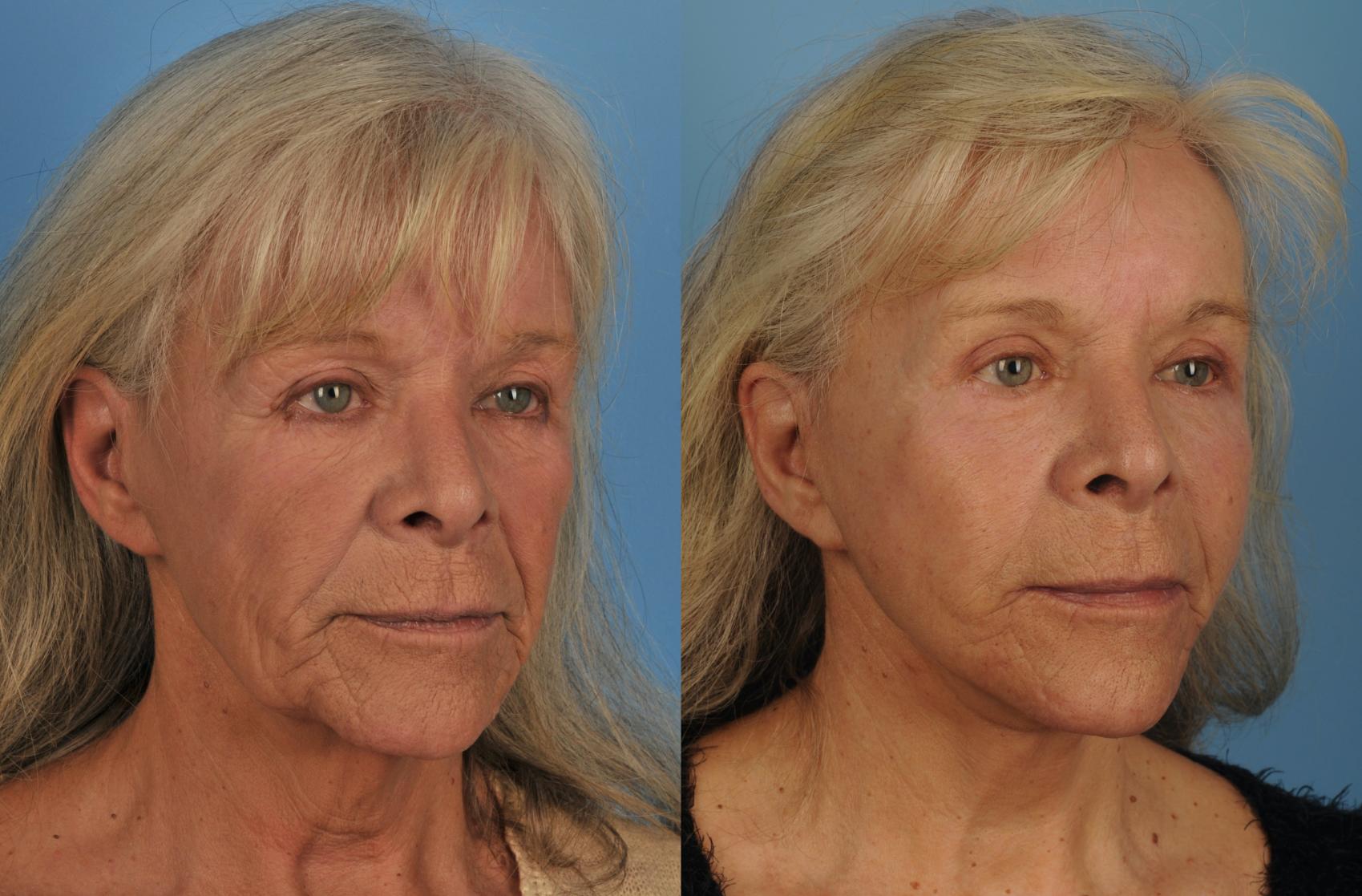 Before & After Facelift/Neck Lift Case 202 View #1 View in Toronto, ON