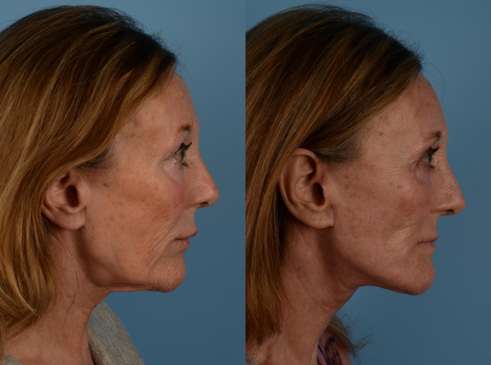 Before & After Facelift/Neck Lift Case 204 View #1 View in Toronto, ON