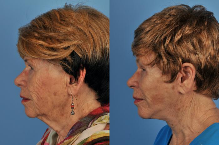 Before & After Facelift/Neck Lift Case 213 View #1 View in Toronto, ON