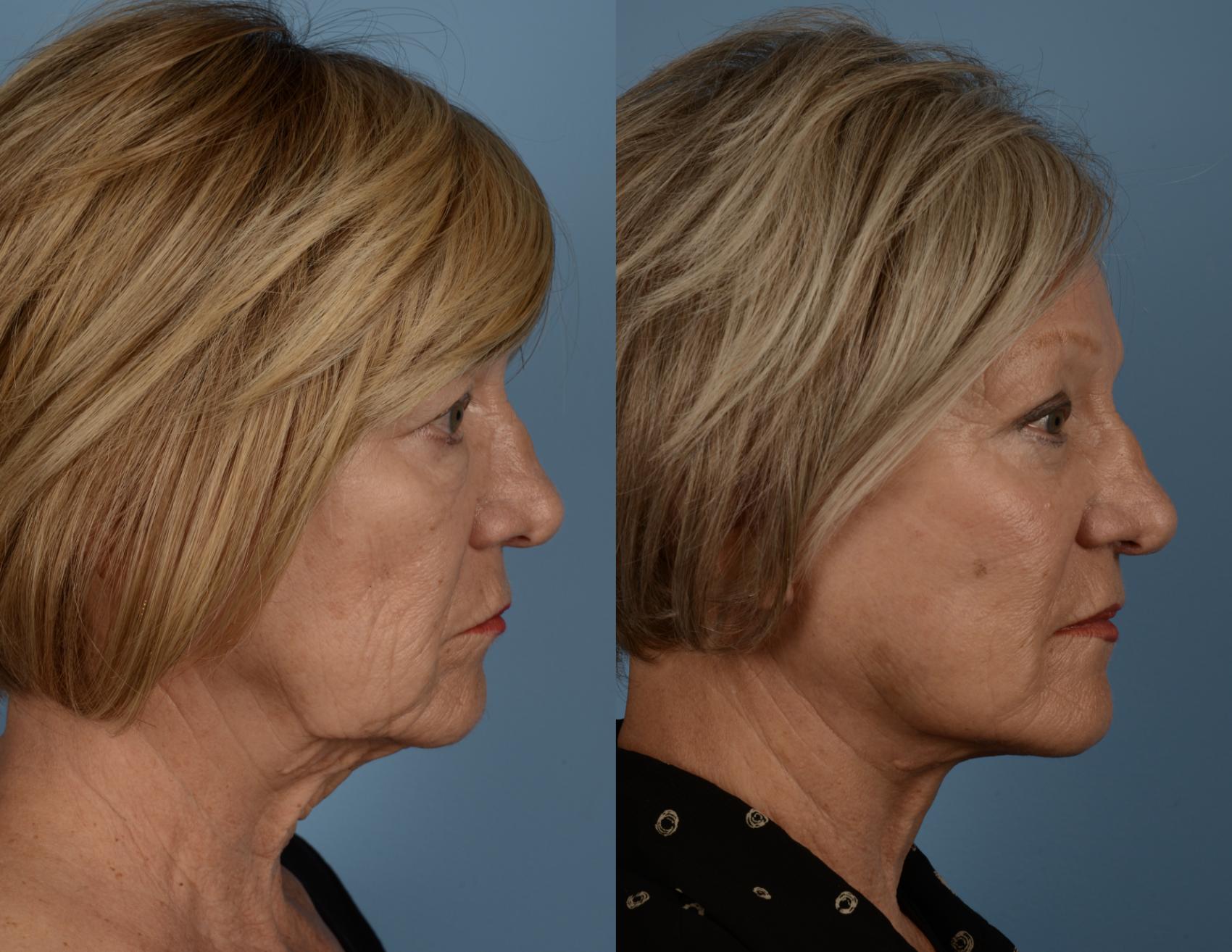 Before & After Facelift/Neck Lift Case 222 View #1 View in Toronto, ON