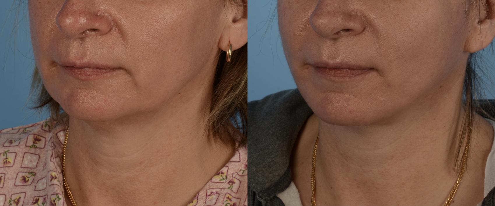 Before & After Facelift/Neck Lift Case 231 View #1 View in Toronto, ON