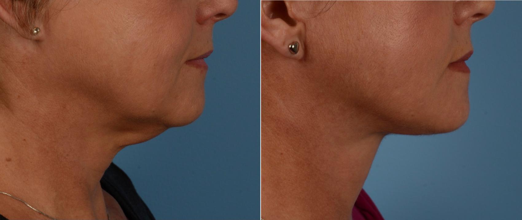 Before & After Facelift/Neck Lift Case 232 View #1 View in Toronto, ON