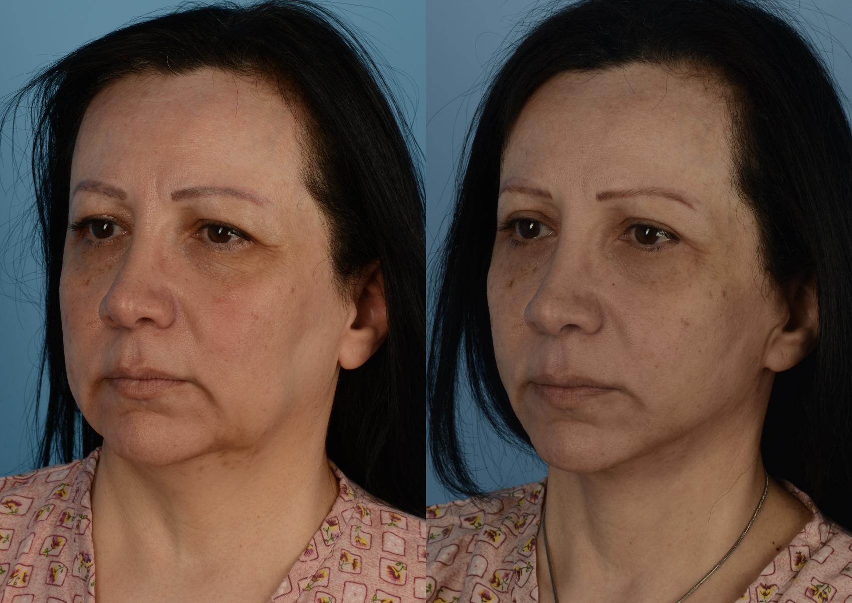 Before & After Facelift/Neck Lift Case 243 Front View in Toronto, ON