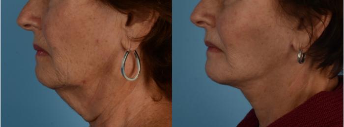 Before & After Facelift/Neck Lift Case 244 Left Side View in Toronto, ON