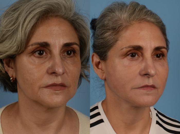 Before & After Facelift/Neck Lift Case 260 Right Oblique View in Toronto, ON