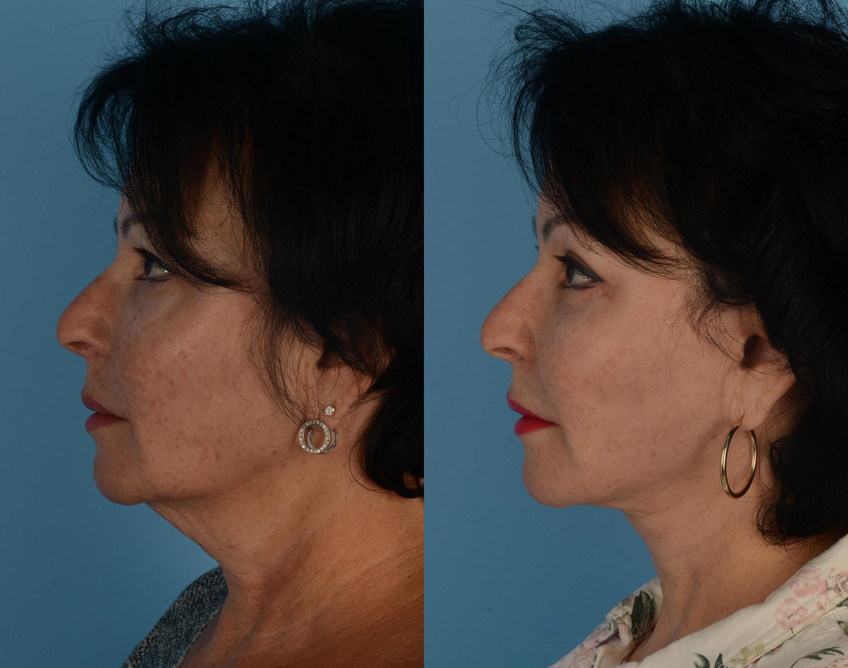 Before & After Facelift/Neck Lift Case 261 Left Side View in Toronto, ON
