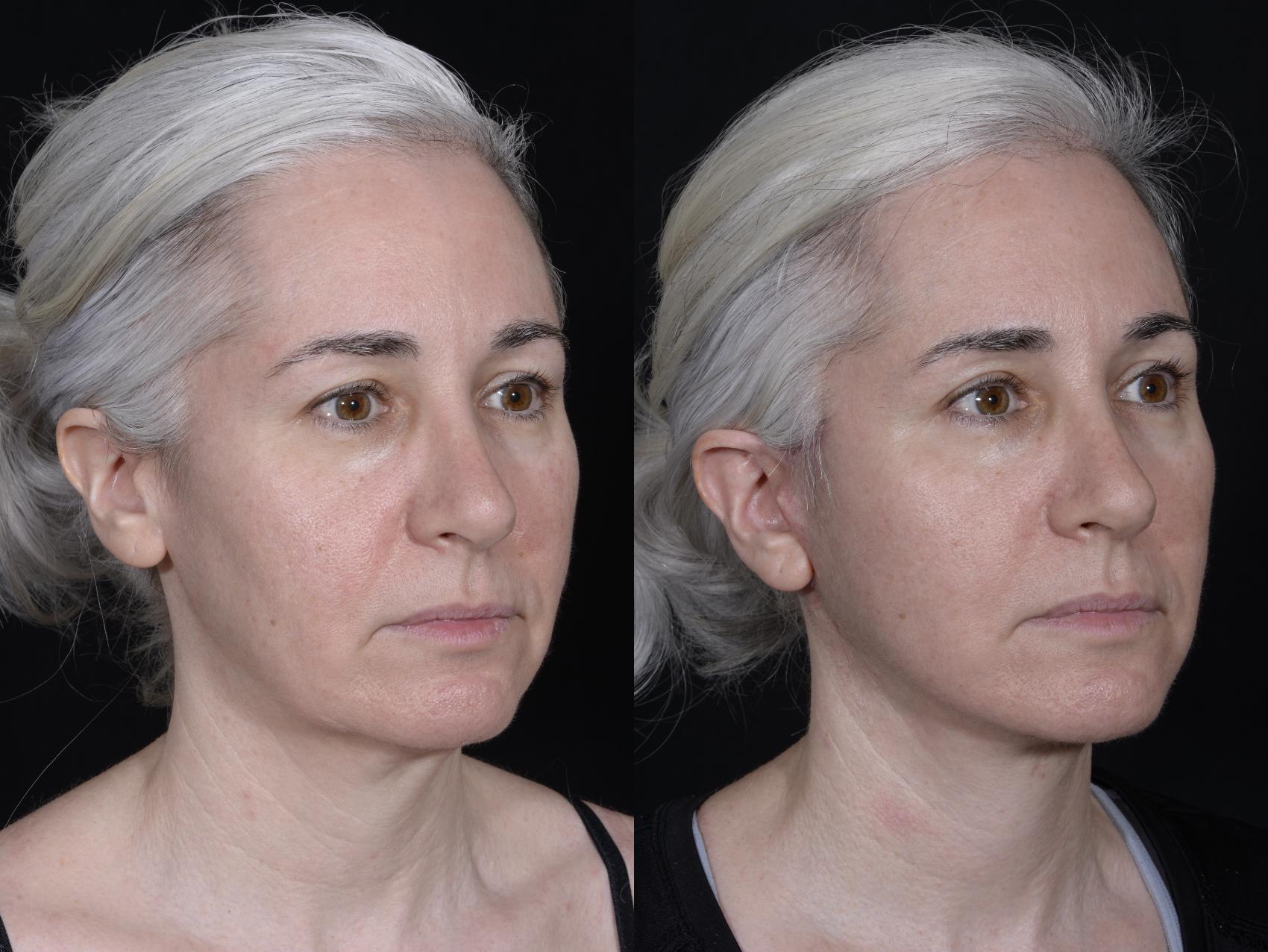 Before & After Blepharoplasty Case 262 Right Oblique View in Toronto, ON