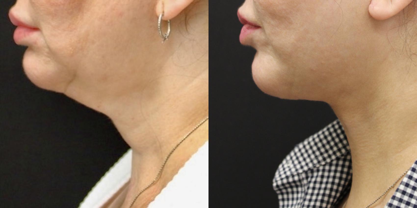 Before & After Facelift/Neck Lift Case 264 Left Side View in Toronto, ON
