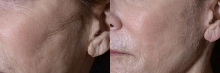 Before & After Scar Management Case 265 Close-up View in Toronto, ON