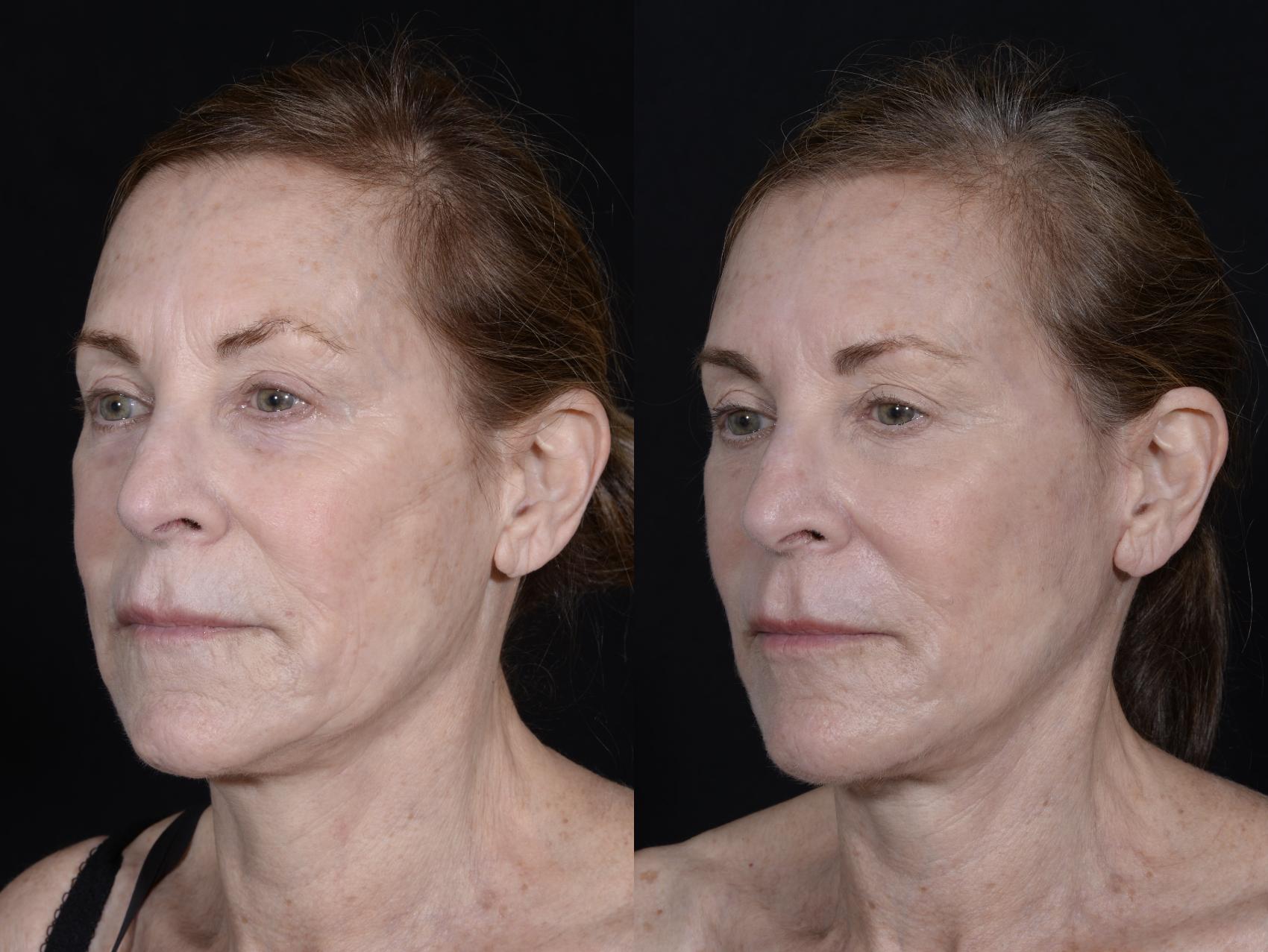 Before & After Facelift/Neck Lift Case 265 Left Oblique View in Toronto, ON