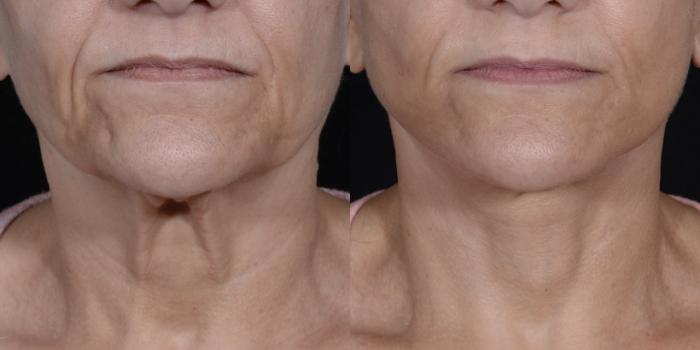 Before & After Facelift/Neck Lift Case 266 Front View in Toronto, ON
