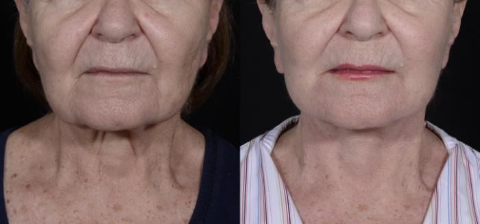 Before & After Facelift/Neck Lift Case 268 Front View in Toronto, ON