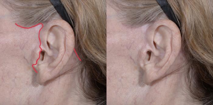 Before & After Scar Management Case 270 Left Side View in Toronto, ON