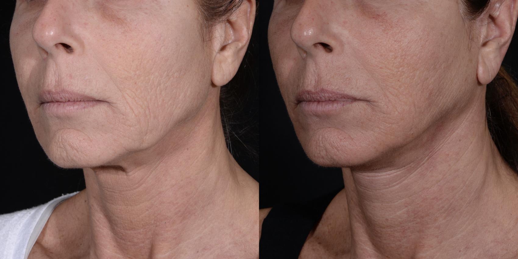 Before & After Facelift/Neck Lift Case 274 Left Oblique View in Toronto, ON
