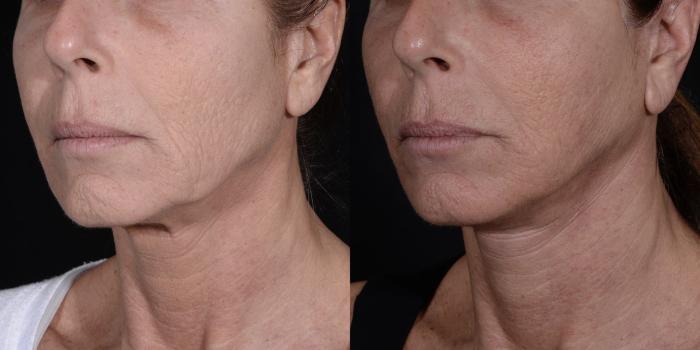 Before & After Facelift/Neck Lift Case 274 Left Oblique View in Toronto, ON