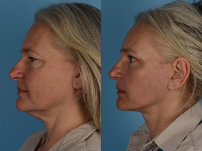 Before & After Facelift/Neck Lift Case 279 Left Side View in Toronto, ON