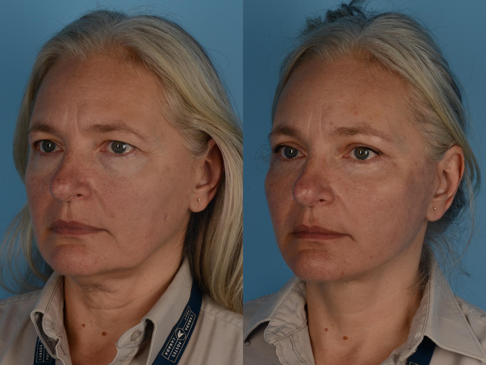 Face/Neck Lift