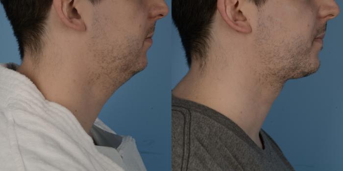 Deep Neck Lift Before and After Photos, Dr. Steven Hanna, Toronto