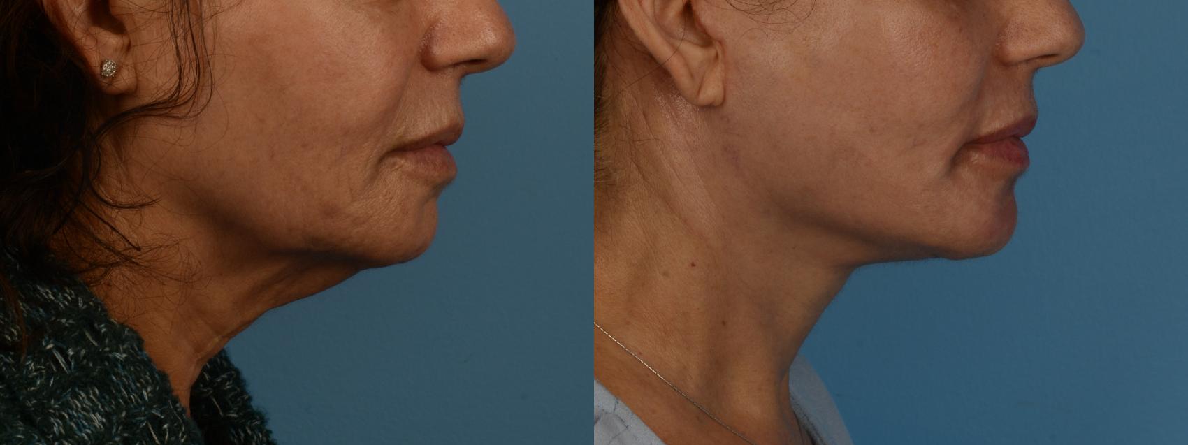 Deep Plane Face/Neck Lift