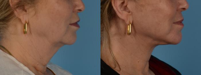 Extended Deep Plane Face/Neck Lift