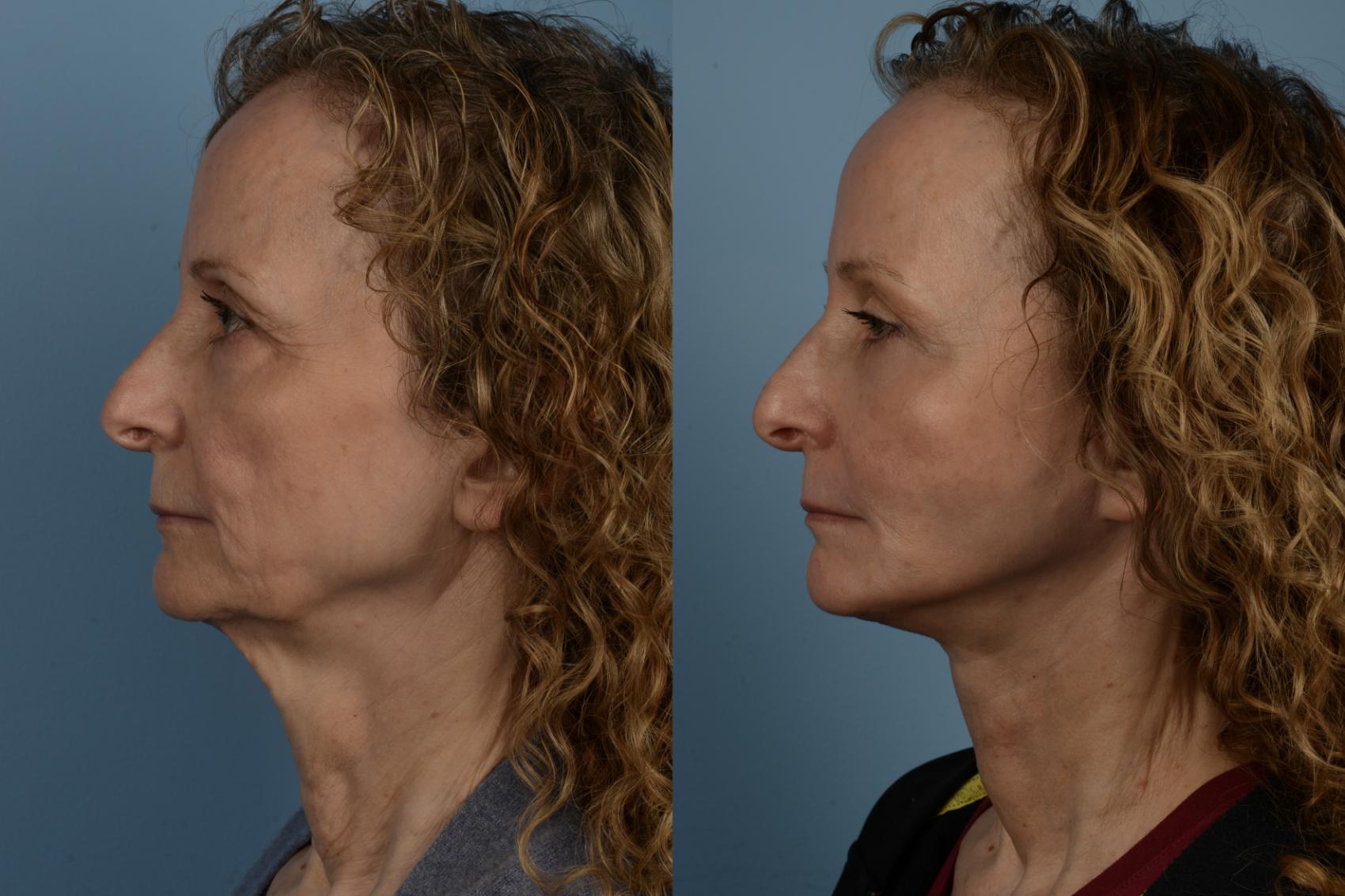 Before & After Facelift/Neck Lift Case 284 Left Side View in Toronto, ON