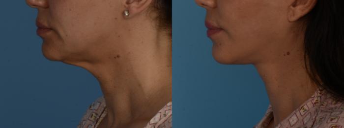 Before & After Facelift/Neck Lift Case 285 Left Side View in Toronto, ON