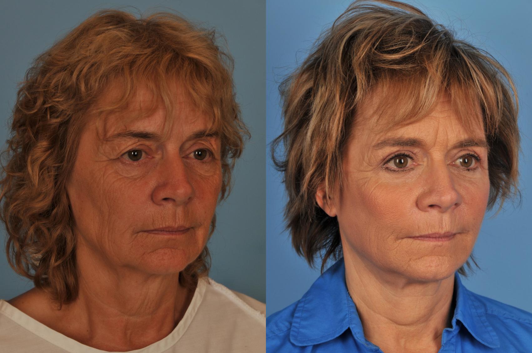 Before & After Facelift/Neck Lift Case 29 View #1 View in Toronto, ON