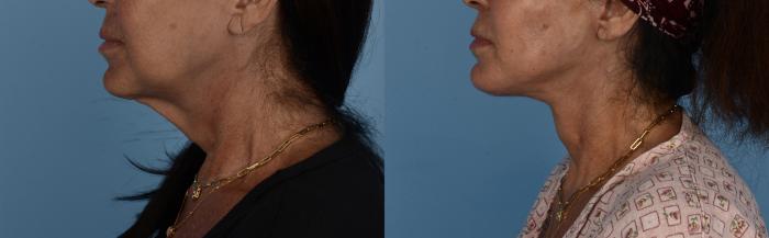 Deep Plane Facelift Before and After Photos, Dr. Steven Hanna, Toronto