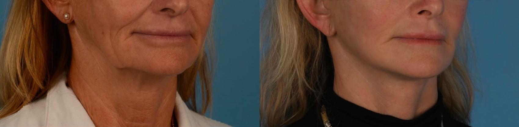 Before & After Facelift/Neck Lift Case 308 Right Oblique View in Toronto, ON