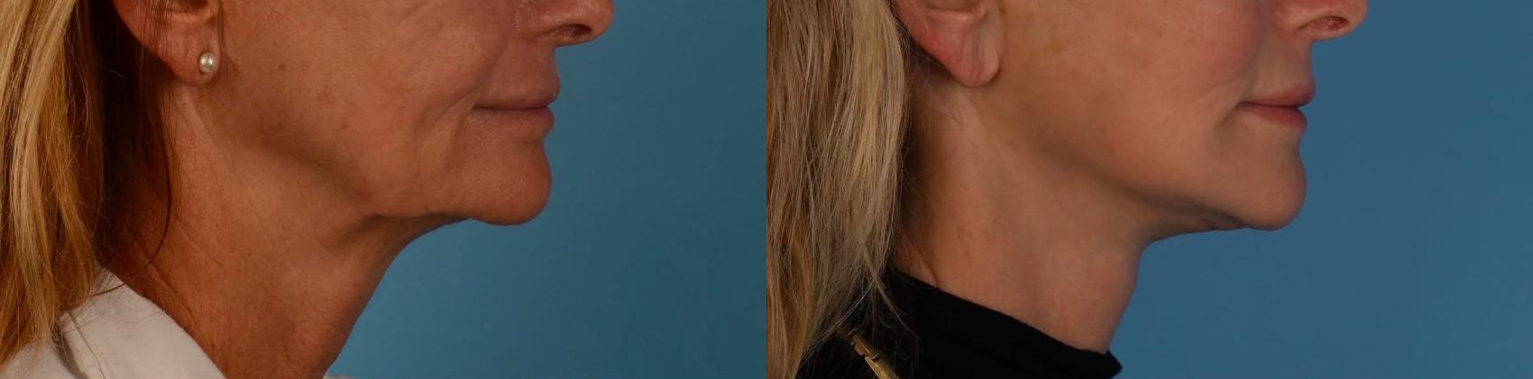 Before & After Facelift/Neck Lift Case 308 Right Side View in Toronto, ON