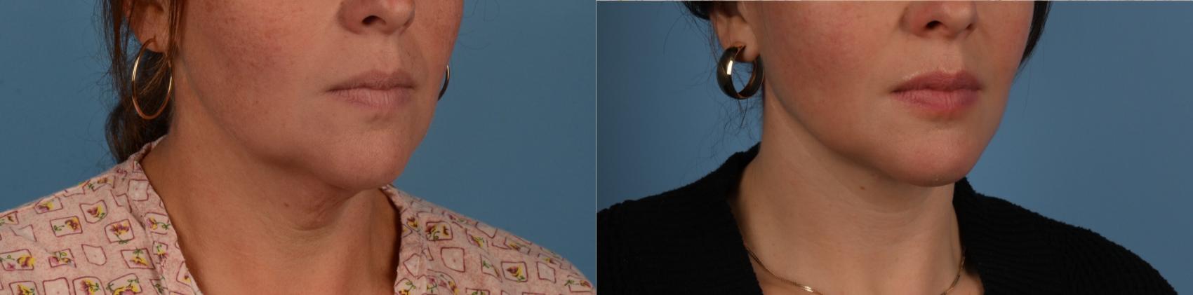 Before & After Facelift/Neck Lift Case 316 Right Angle View in Toronto, ON