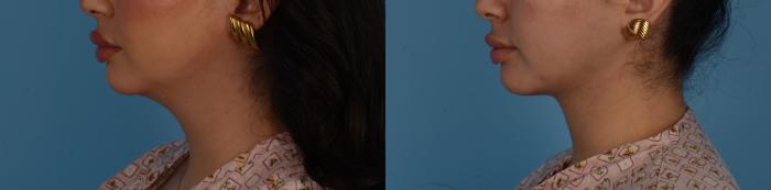 Before & After Facelift/Neck Lift Case 329 Left Side View in Toronto, ON