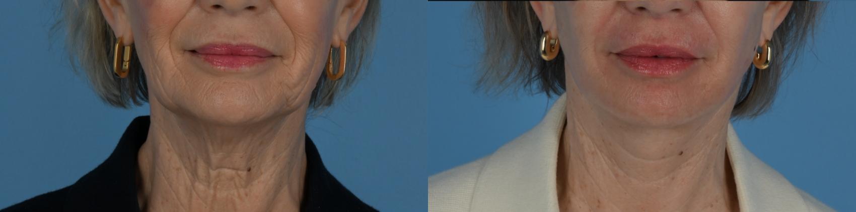 Before & After Facelift/Neck Lift Case 331 Front View in Toronto, ON