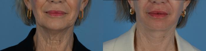 Before & After Facelift/Neck Lift Case 331 Front View in Toronto, ON